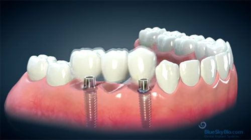 Dental Implant