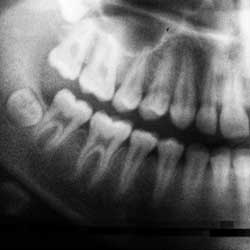 dental xray image