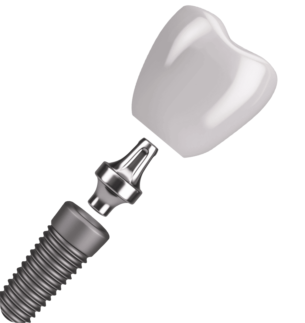 Illustration of a dental implant crown, abutment and implant fixture