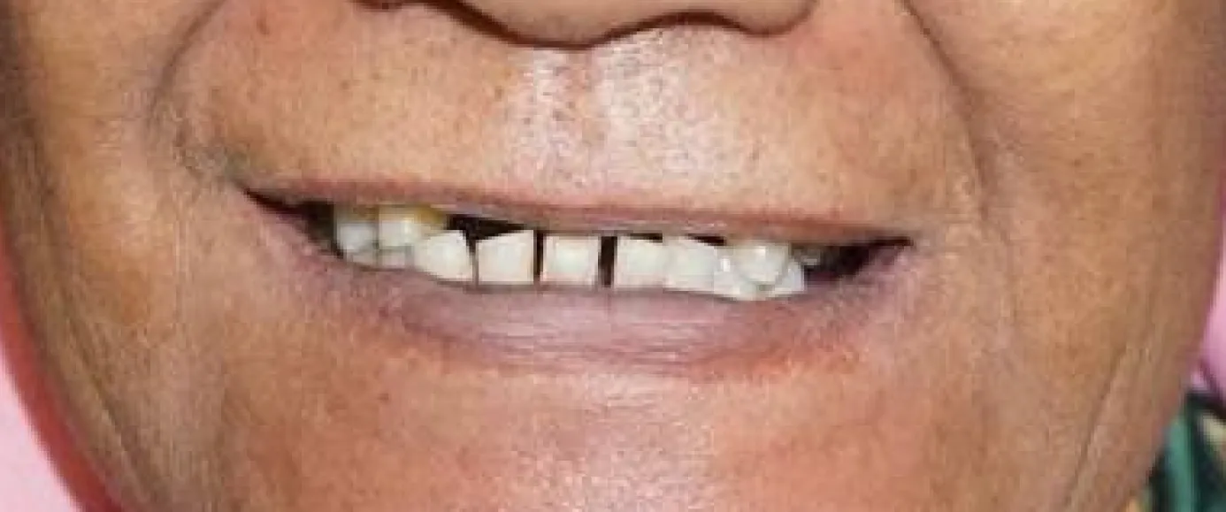 Before view of dental treatment by Dr. Desmond Ng