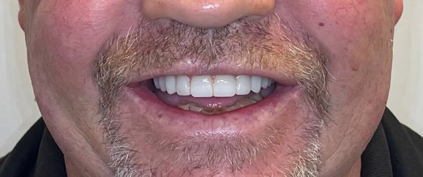 After view of dental treatment by Dr. Desmond Ng