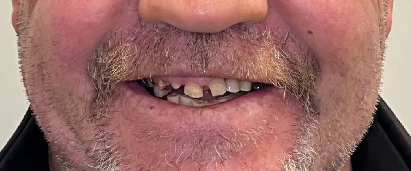 Before view of dental treatment by Dr. Desmond Ng