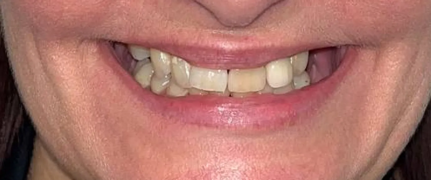 Before view of dental treatment by Dr. Desmond Ng