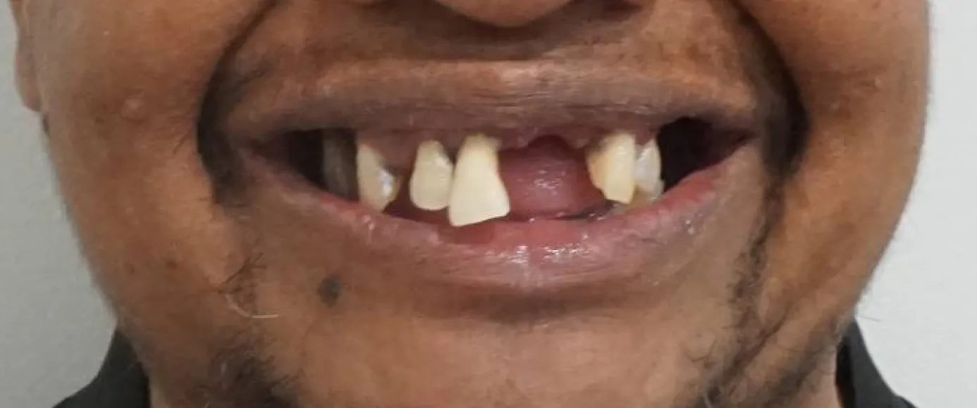 Before view of dental treatment by Dr. Desmond Ng